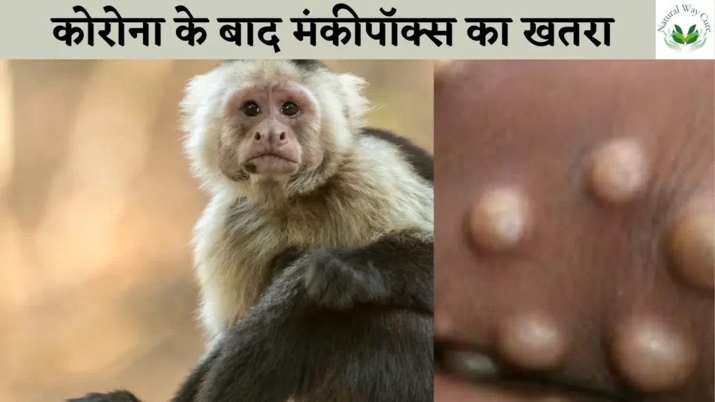 What is monkeypox in hindi