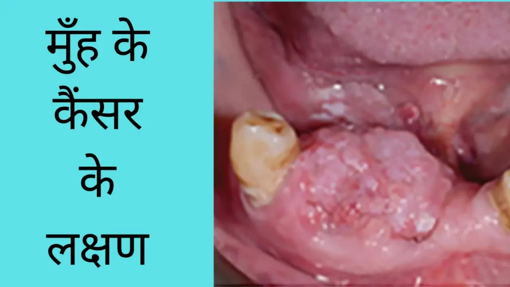 Symptoms of mouth cancer in hindi