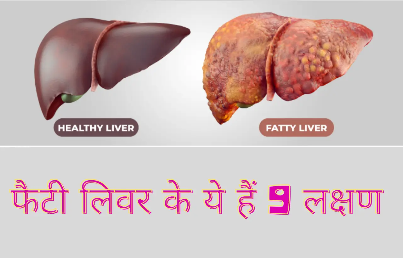 Fatty liver ke lakshan in hindi