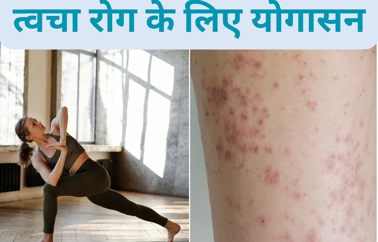 Yogasan for skin diseases in hindi