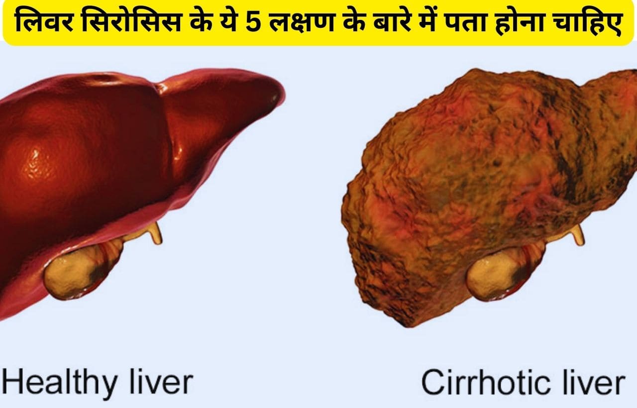 5 Warning Signs Of Liver Cirrhosis in hindi